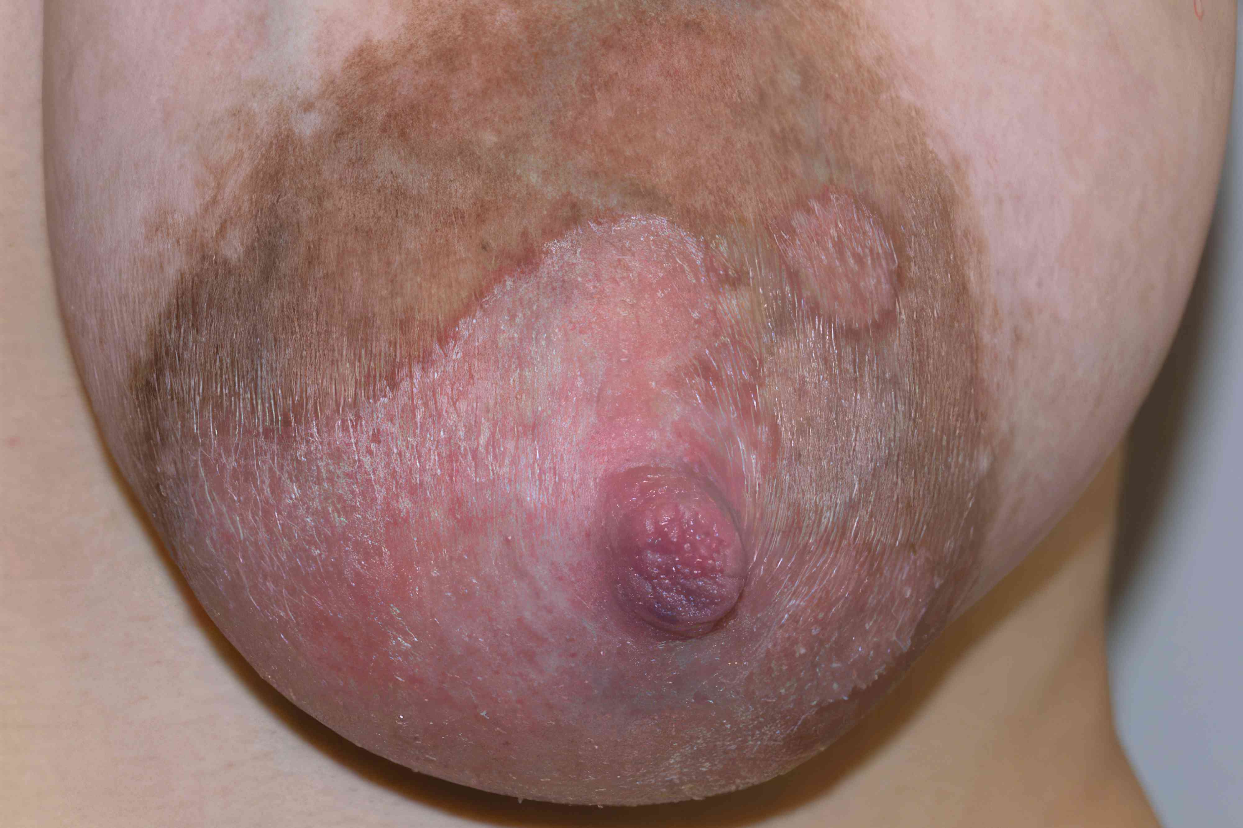 bruce honeycutt recommends breast nipple pic pic