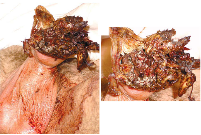 abraham garay recommends Maggots In Penis