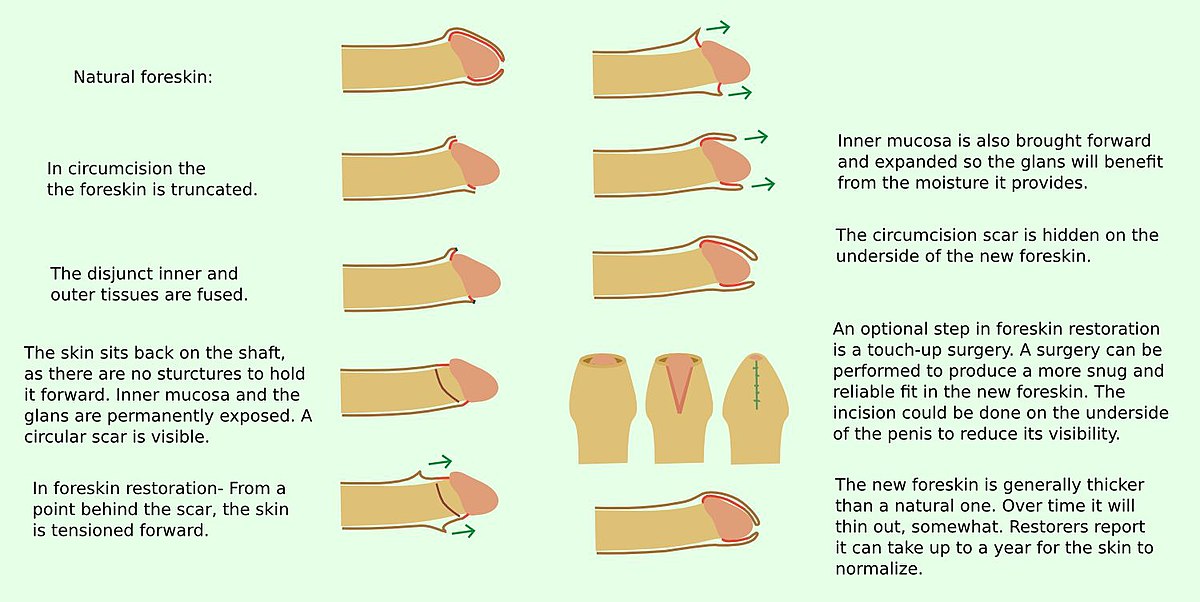 armaan sandhu recommends pictures of foreskin restoration pic