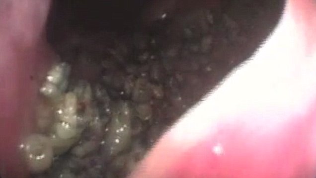 Best of Maggots in penis