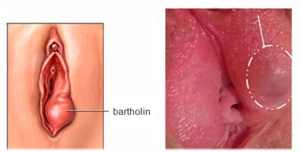 brittani ward recommends bartholin cyst hard as a rock pic