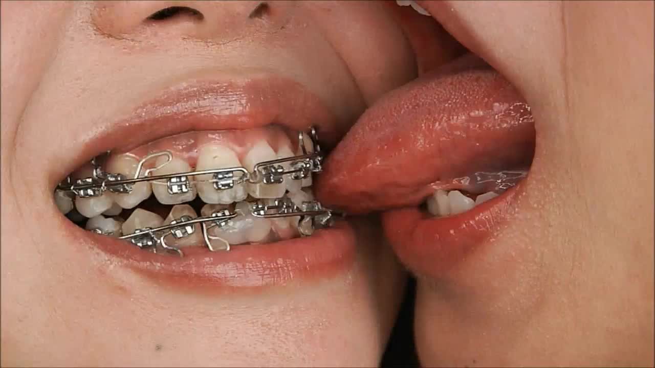 brianna gilson recommends cum on braces compilation pic
