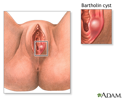 antonella camilleri recommends bartholin cyst hard as a rock pic