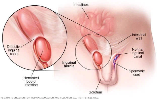 Best of Inguinal canal tucking