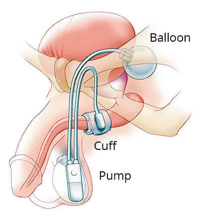 darren neil add photo pumping air into urethra